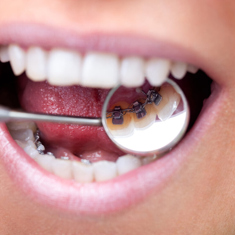 Closeup Of Lingual Braces